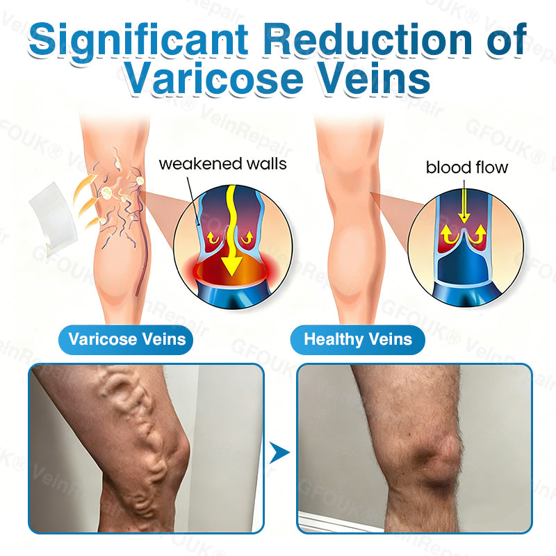 🇺🇸✅️🌱GFOUK® VeinRepair Microneedle Patch Roll⚡Instant Relief, Long-Term Results