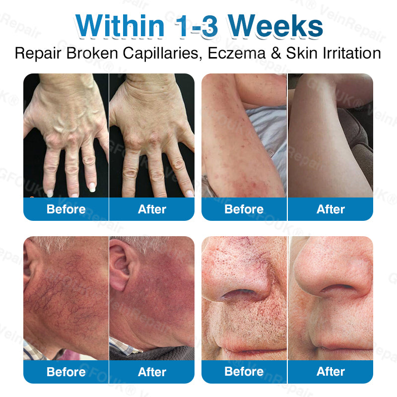 🇺🇸✅️🌱GFOUK® VeinRepair Microneedle Patch Roll⚡Instant Relief, Long-Term Results