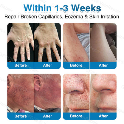 🇺🇸✅️🌱GFOUK® VeinRepair Microneedle Patch Roll⚡Instant Relief, Long-Term Results