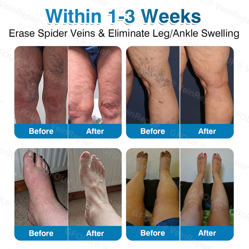 🇺🇸✅️🌱GFOUK® VeinRepair Microneedle Patch Roll⚡Instant Relief, Long-Term Results