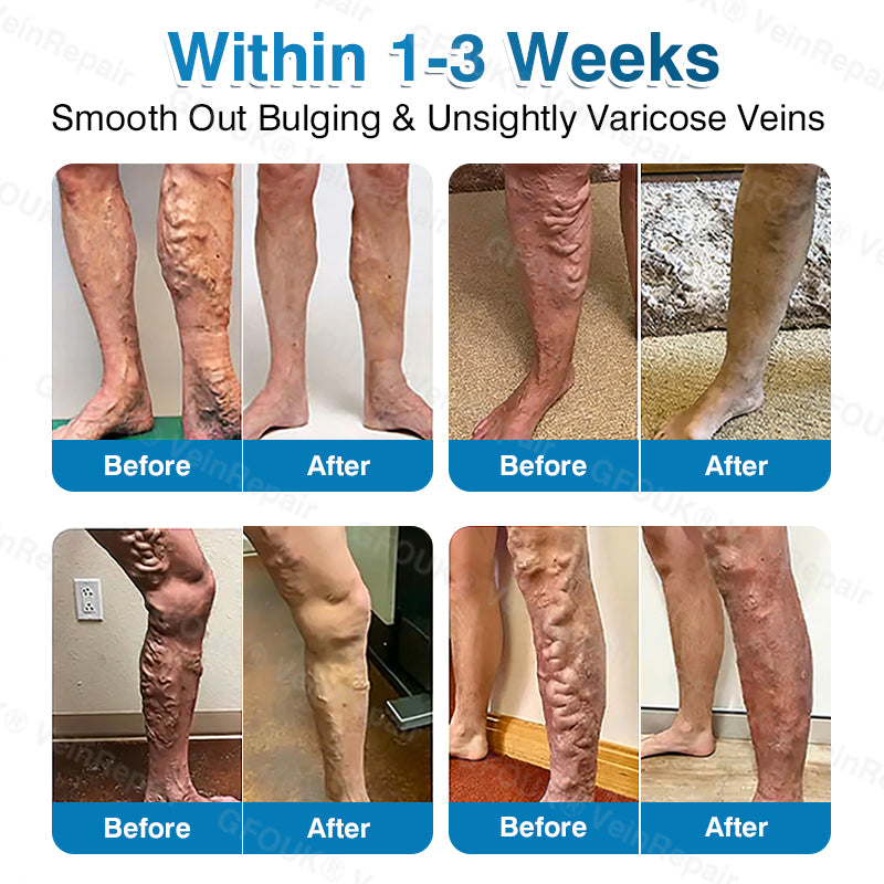 🇺🇸✅️🌱GFOUK® VeinRepair Microneedle Patch Roll⚡Instant Relief, Long-Term Results